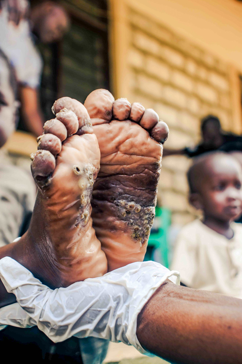 A patient's feet before treatment, showing the jigger infestation being treated